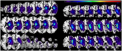 The locations of stroke lesions next to the posterior internal capsule may predict the recovery of the related proprioceptive deficits